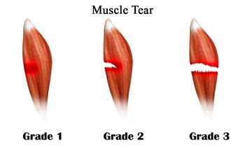 what test will show a muscle tear|grade 3 muscle tear symptoms.